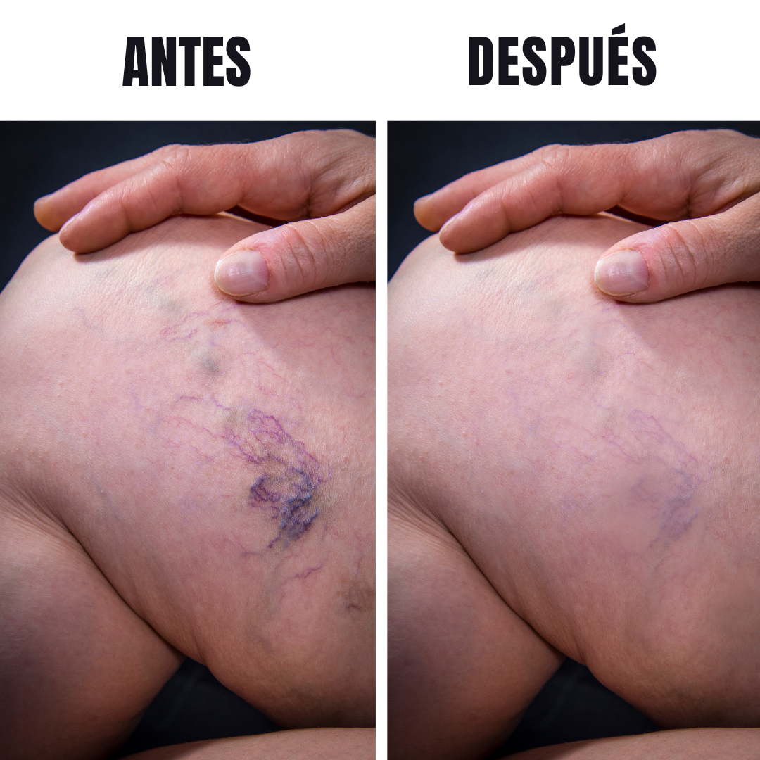 Variless 30 Cápsulas – Complemento alimenticio que ayuda a mejorar la circulación de las piernas®