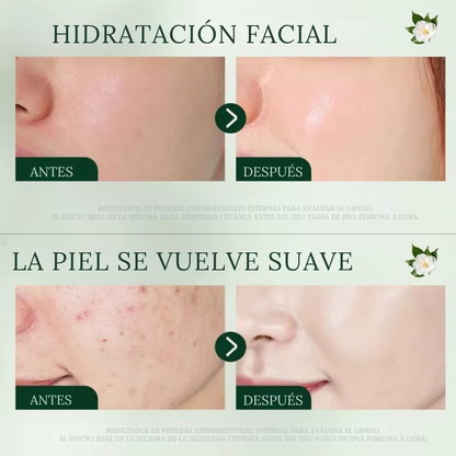 Crema Facial Antiacné con Aceite de Árbol de Té 50ml - SADOER (OFERTA 2x1)
